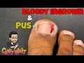 INGROWN TOENAIL, EXTREMELY FUNNY PATIENT