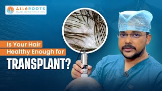 Hair Transplant Planning | Microscopic Hair Analysis Guide | Dr.Alok | Trichoscopy | @alloroots​