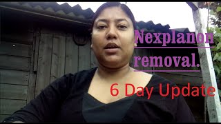 Nexplanon Removal 6 day update