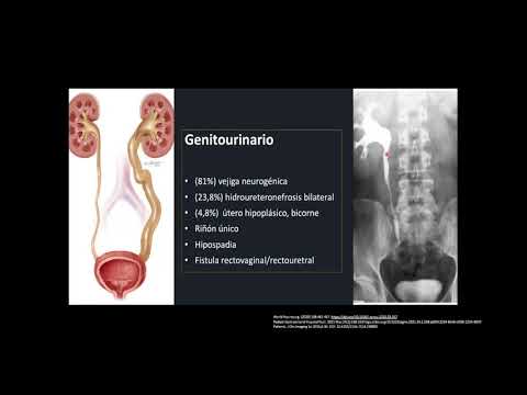 Síndrome de regresión caudal