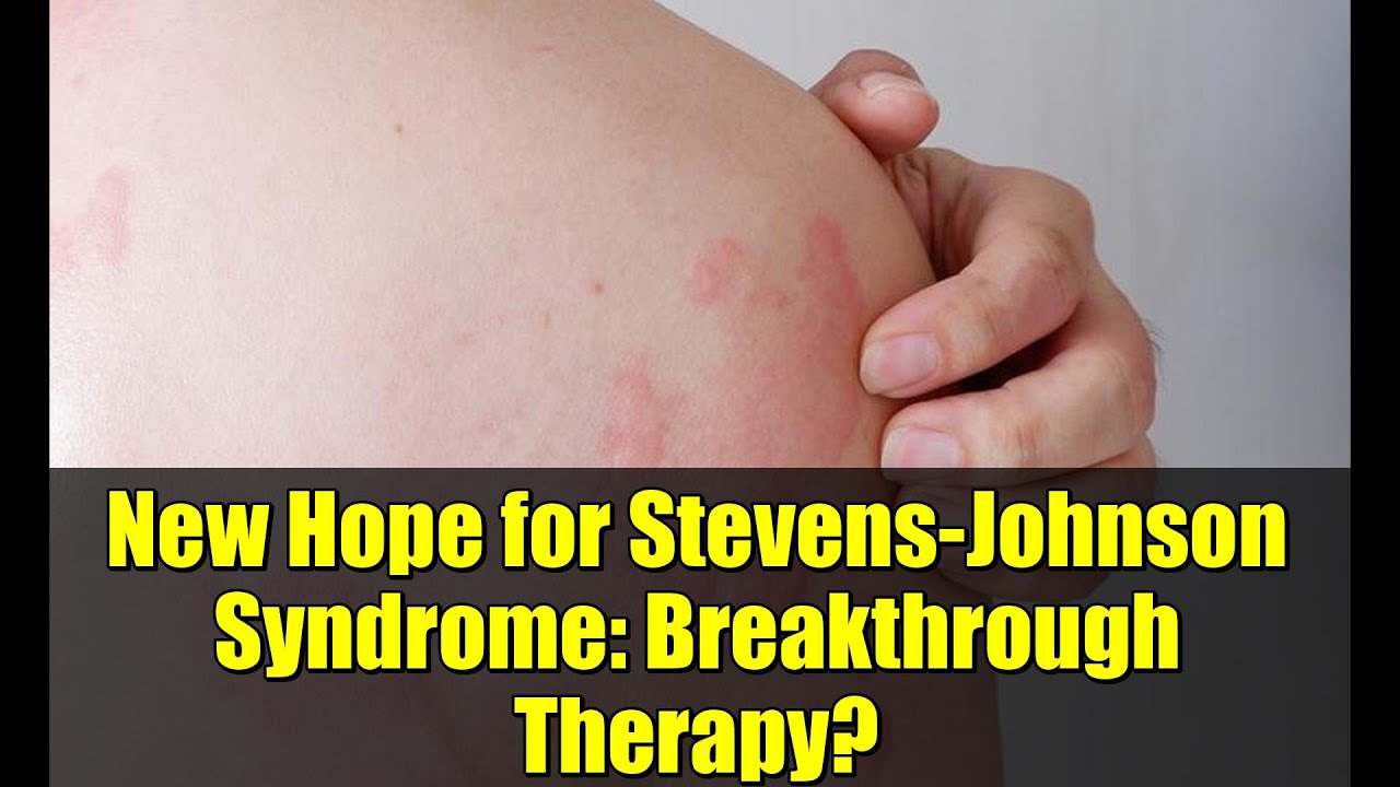 New Hope for Stevens-Johnson Syndrome: Breakthrough Therapy?
