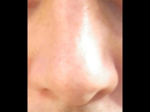 Nasal Polyps Cure - YouTube