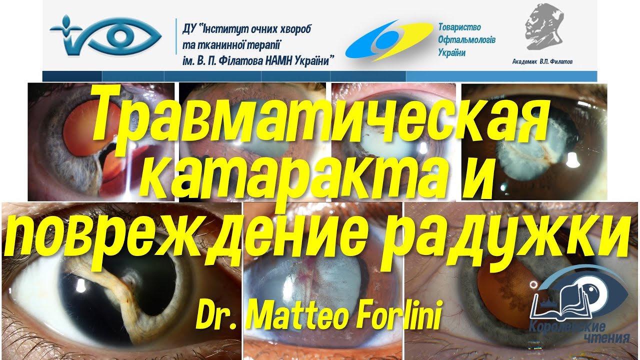 Травматическая катаракта и повреждение радужки - YouTube