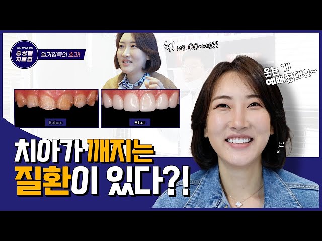 깨지는 치아질환, 해결 할 수 있을까?| 에나멜형성부전증