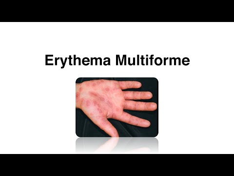 Erythema Multiforme -