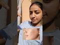 best home remedy for acne #acnetreatment #acne #homeremedy #youtubeshorts #glassskin