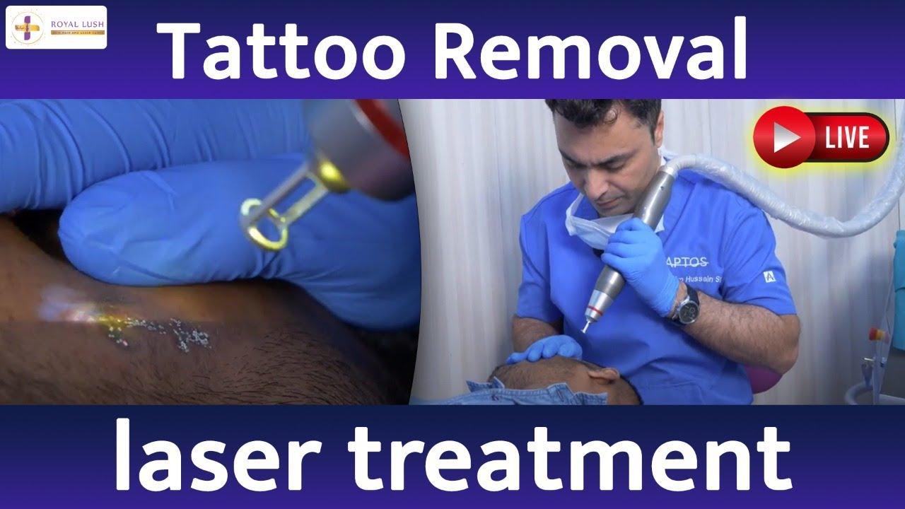 How To Remove Tattoo Tattoo Removal Laser Treatment In Delhi Saket how-to-remove-tattoo-tattoo-removal-laser-treatment-in-delhi-saket