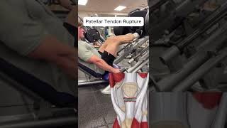 Patellar Tendon Ruptures During Leg Press