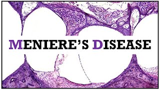 Meniere's disease (Idiopathic endolymphatic hydrops)