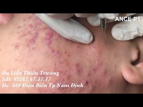 ĐIỀU TRỊ MỤN ẨN MỤN VIÊM AN TOÀN - HIỆU QUẢ