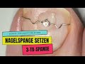 Nagelspange / 3 TO Spange bei eingewachsenen Nägeln anwenden