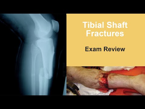 Tibial Shaft Fractures Exam Review - Jan Szatkowski, MD