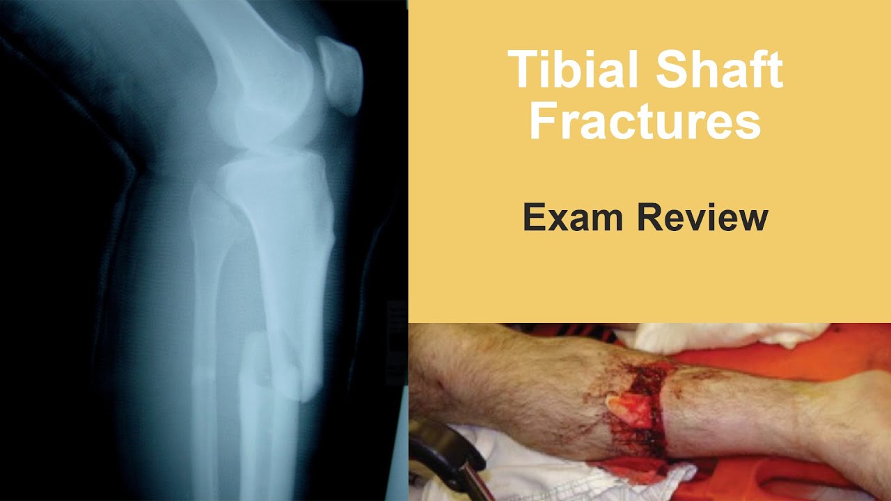 Tibial Shaft Fractures Exam Review Jan Szatkowski MD YouTube Tibial Shaft Fractures Exam Review Jan Szatkowski MD YouTube
