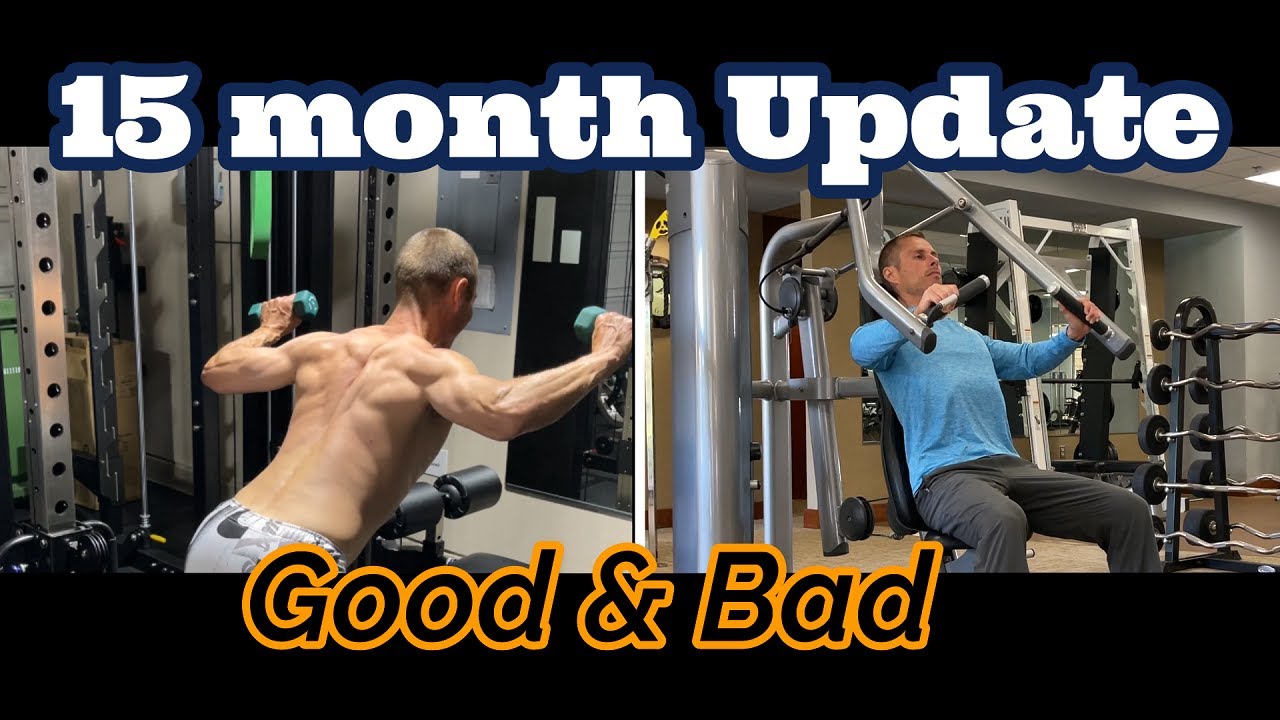 AC joint surgery pros and cons 15 months later Distal Clavicle