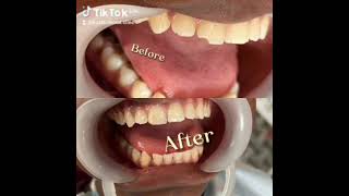 A little crack could lower your self esteem. #toothfilling #compositefilling #dentalfilling #bozid