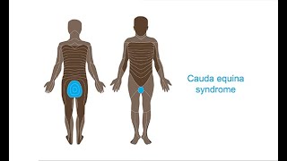 Managing cauda equina syndrome–Neurology Masterclass