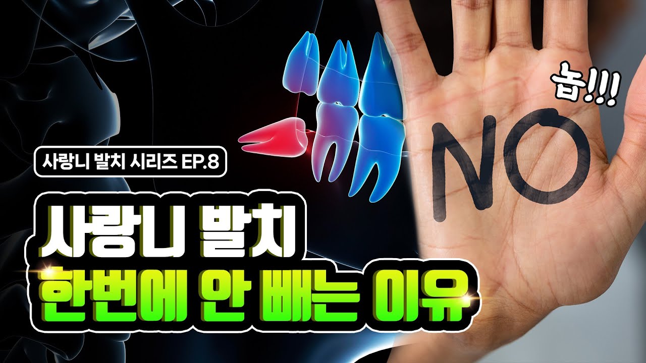 사랑니 4개 동시 발치, 위험할 수 있습니다! 4개를 발치 해도 되나요?