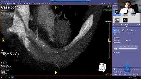 Algorithm 102 Five Steps plus Basic 3D Thorax Anat