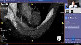 Famous Algorithm 102 Five Steps plus Basic 3D Thorax Anat Net Worth
