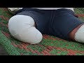 Live Prosthetic Gait Training for Above Knee Amputee 🦿 Disability Awareness