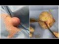 肩の巨大な粉瘤　切開による摘出　 large epidermal cyst of shoulder. ブログでも詳しく解説　ふるばやし形成外科粉瘤クリニック　東京新宿院　大阪梅田形成外科クリニック