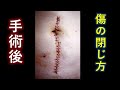 キズの閉じ方　抜糸　縫合　外科医　解説　手術　方法