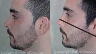 Over Resection in Rhinoplasty | Beverly Hills Profiles