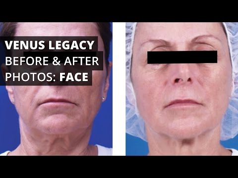 Venus Legacy™ Before & After Photos: Face