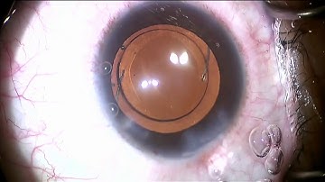 3 Piece Intraocular Lens Insertion