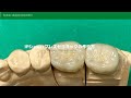 【歯科技工】IPS:emaxプレスセラミックの作り方How to make pressed ceramics emax Dental technician at work