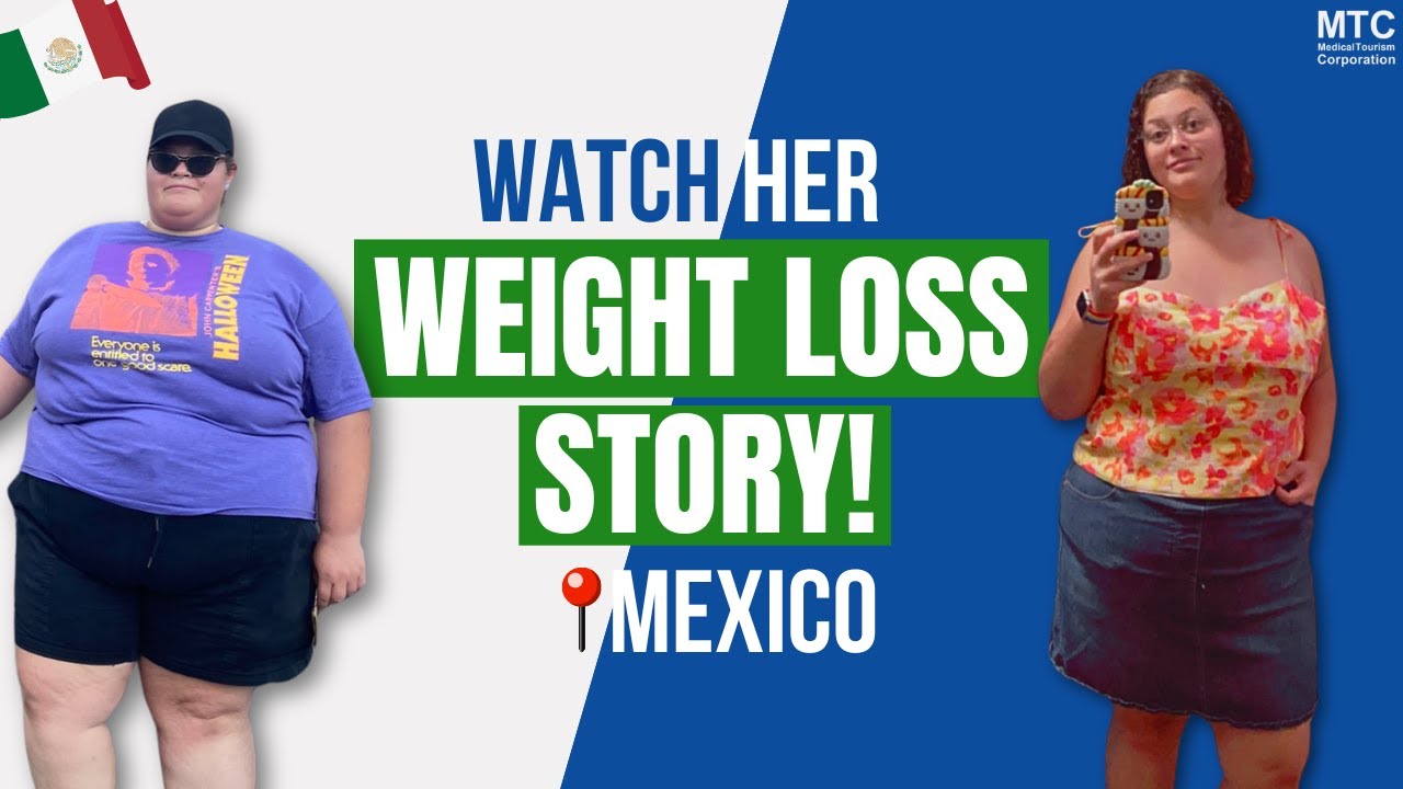 Weight Loss Surgery in Tijuana Review Alexis’ Journey From Struggles