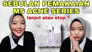 SEBULAN PEMAKAIAN MS GLOW ACNE SERIES | REVIEW JUJUR MS GLOW ACNE SERIES BASIC