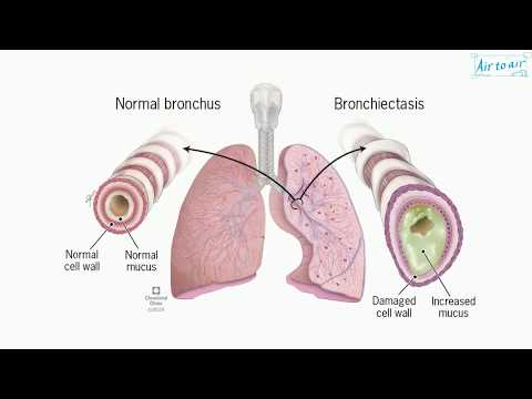 Video: Bronchiectasis - Glossary Of Medical Terms