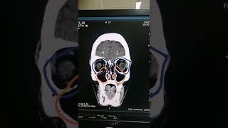 Farhr Syndrome Syndrome Of Head Calcific Densities Seen On Ct Dr Green Side Medical Imaging