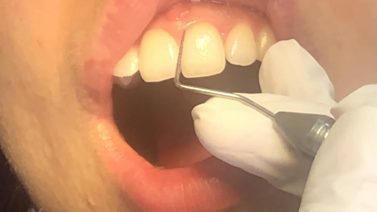 Plak İndeksi, Dişeti Kanama İndeksi, Cep derinliği