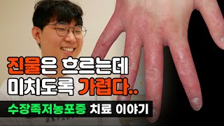 수장족저농포증 원인과 증상, 실제 치료사례입니다!