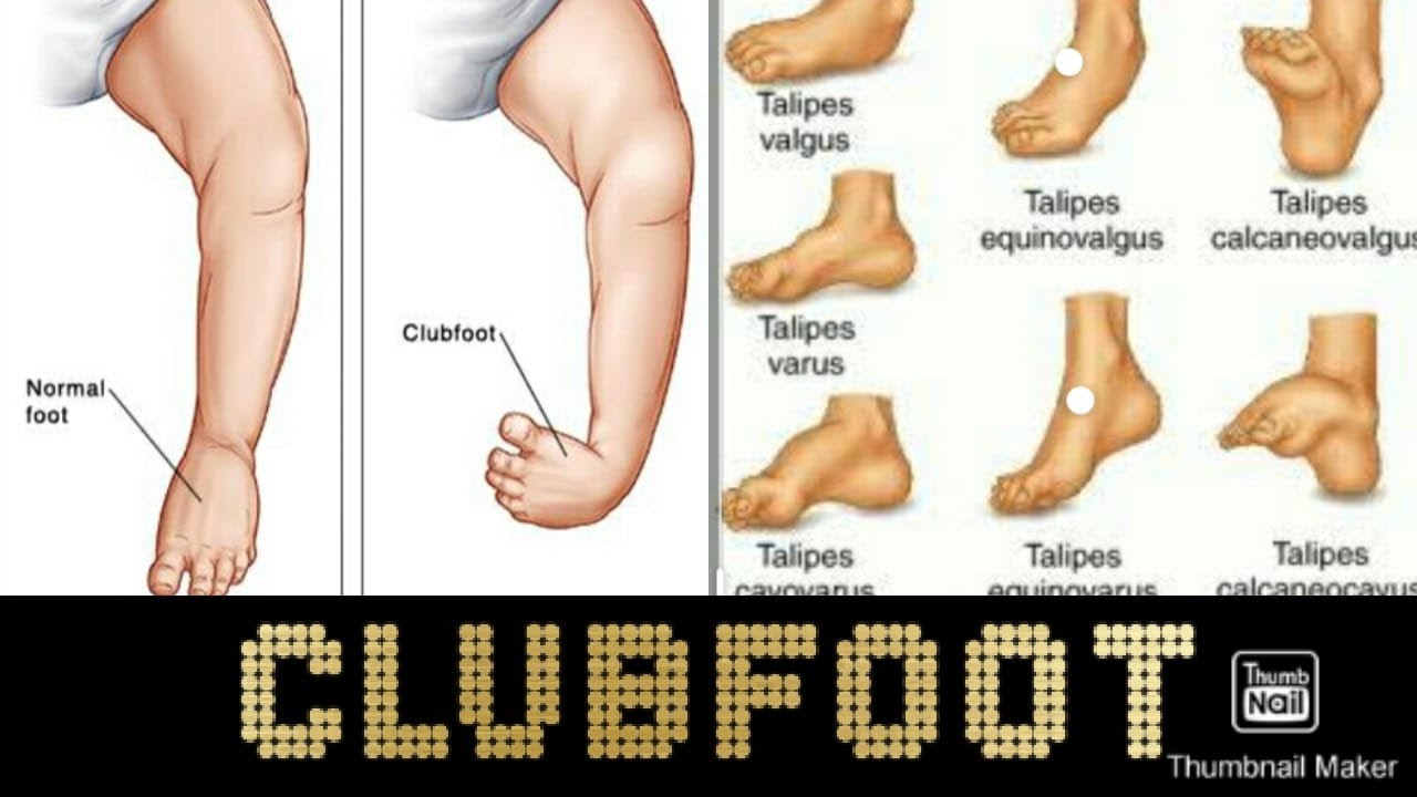 Clubfoot Its Types And Causes Simplified In Hindi Youtube