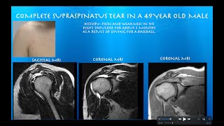 Ultrasound of a Complete Supraspinatus Tear,  by probeultrasound.com