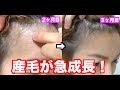 【ハゲ日記】AGA薄毛治療3ヶ月目！
