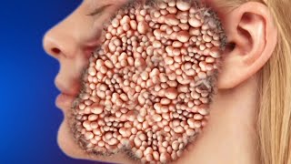 ASMR Animation Treatment 🤕 Removal Cytes, worm, & dig tick from infected cheek | 2d Deep Cleaning