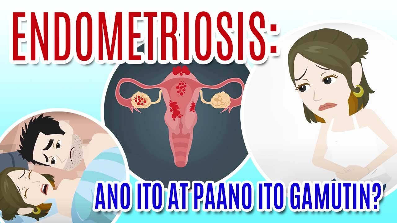 ENDOMETRIOSIS: Ano ito at Paano ito Ginagamot?