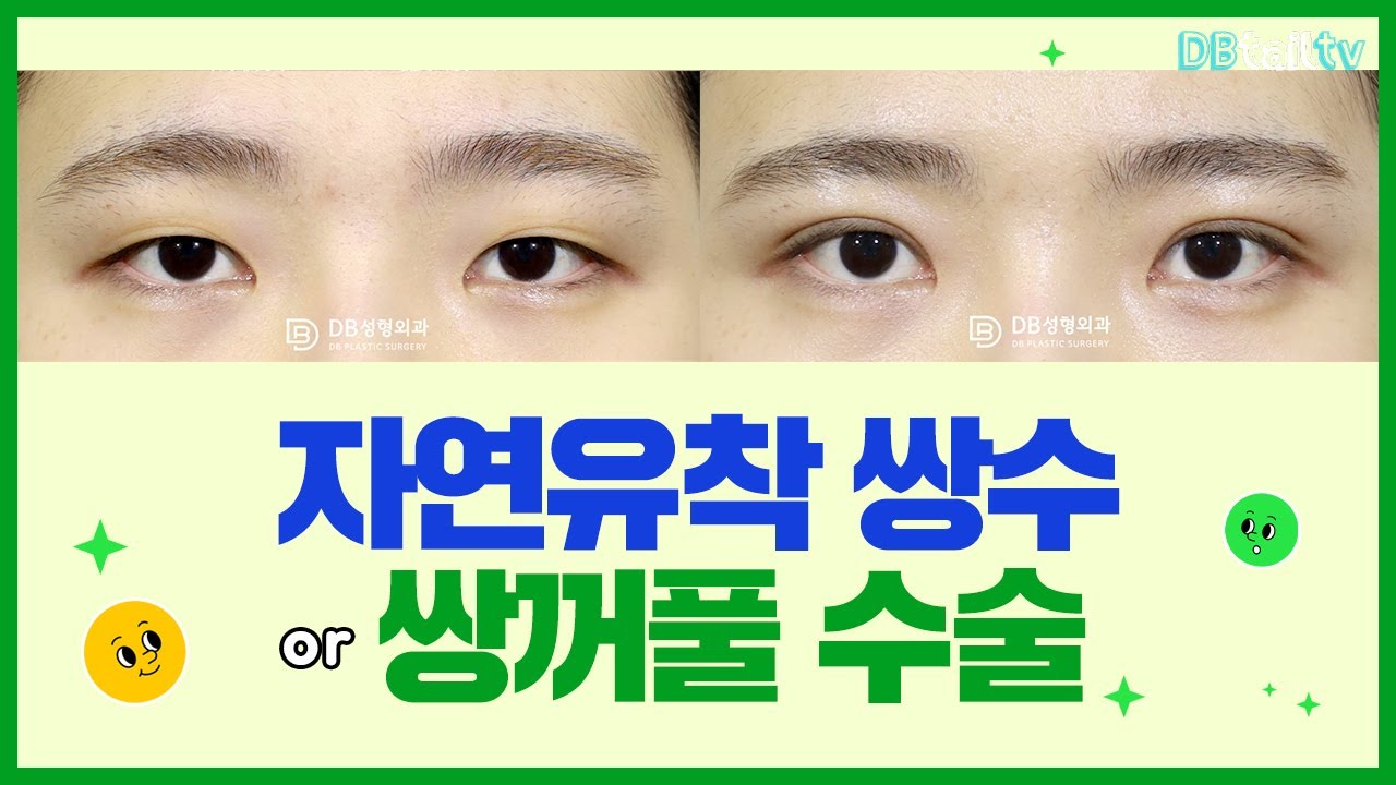 자연유착 쌍수 or 쌍꺼풀 수술 - YouTube
