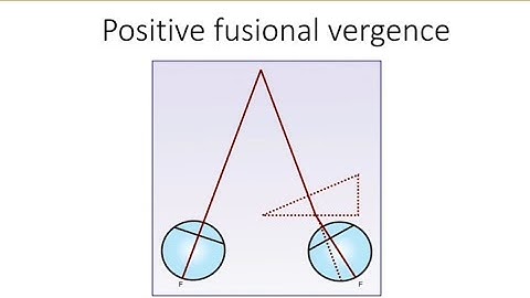 Orthopics series 5 : Positive fusional vergence ( PFV )