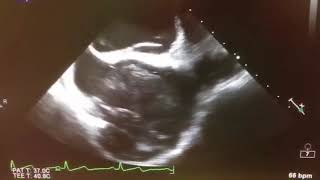 Asvide: Bubble saline injection in intra-operative transesophageal echocardiogram