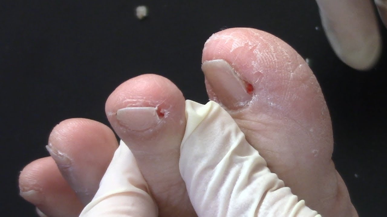 Satisfying Ingrown Toenail Removal YouTube