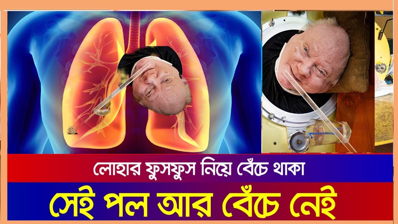 মারা গেছেন ৭০ বছর ‘লোহার ফুসফুসে’ বেঁচে থাকা পল Iron Lung Paul