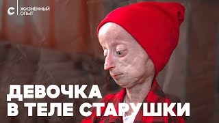 Девочка в теле старушки: как живет школьница с прогерией