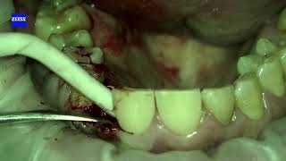 Имплантация