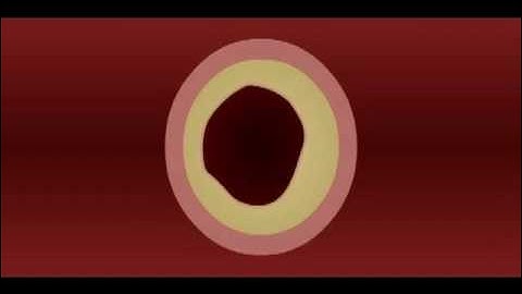 The Silent Killer - Hypertension.flv