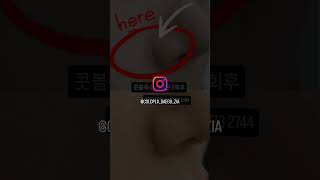 #콧볼축소 #대구플라즈마 #지아뷰티 #플라즈마수강